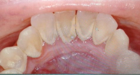 teeth calcium buildup tartar deposits leblanc dds